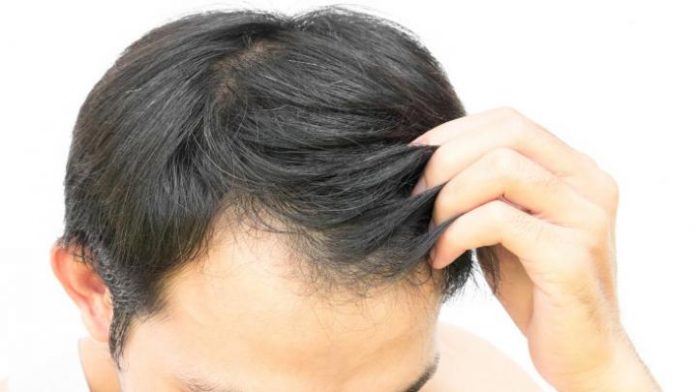 hair transplant_3