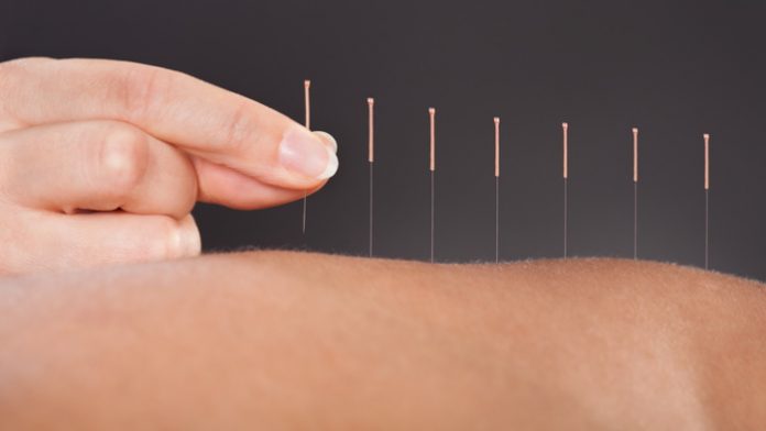 Close-up Of A Person Getting An Acupuncture Treatment At Spa