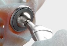 Keep on moving: hip and knee replacement in the independent sector