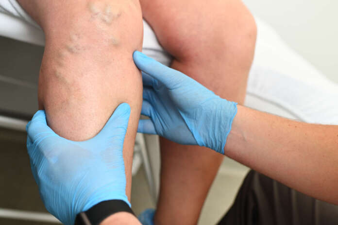 hlebologist examines a patient with varicose veins on his leg