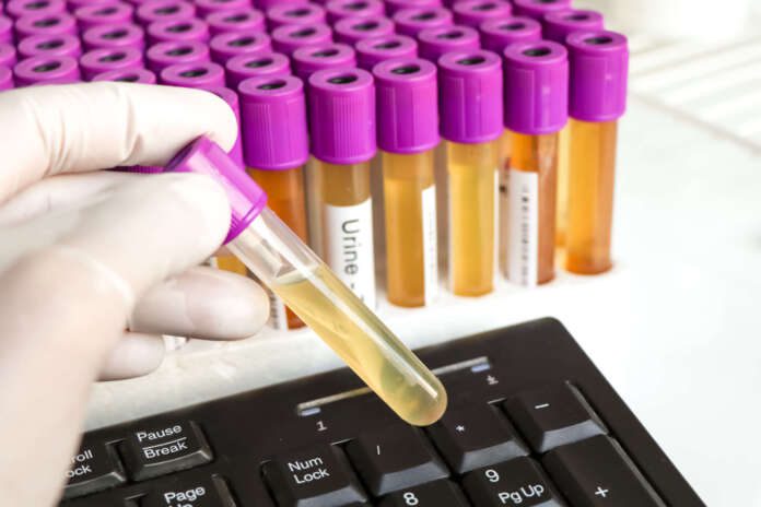Urine test to look for abnormalities from Urine, Urine sample to analyze in the laboratory